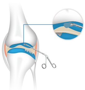 STEP 1.膝蓋軟骨組織採集